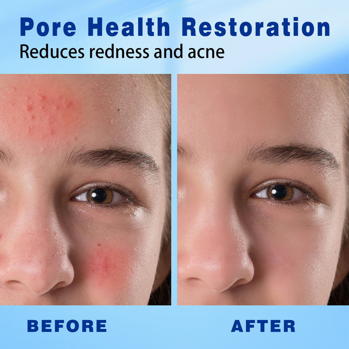 Séfralls 15% Azelaic Acid Acne Cream - Dark Spot Remover (30g)